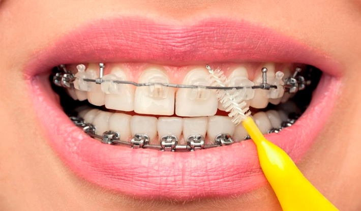 how to take care of braces