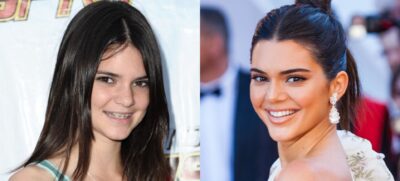 Celebrities with braces