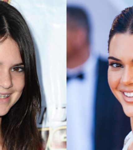 Orthodontics Australia  6 Celebrities With Braces Before and After —  Wonderful Transformations