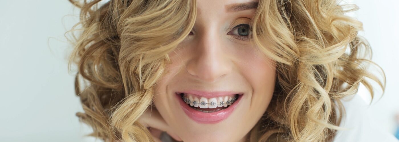 Are metal braces the only option?