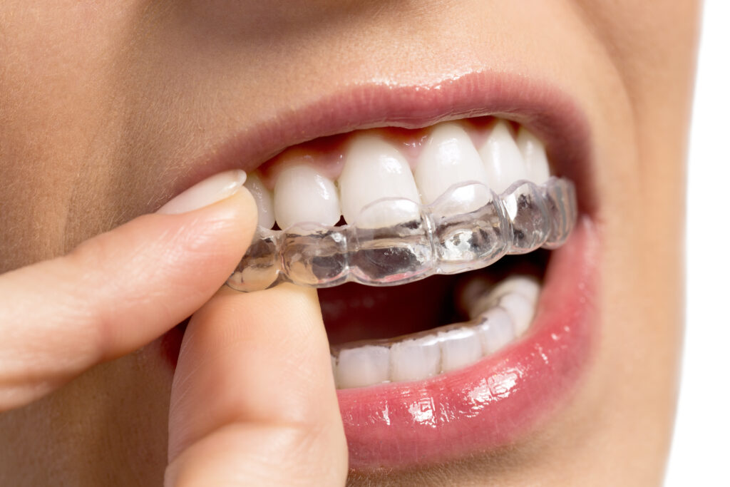 Is there really such a thing as invisible braces?
