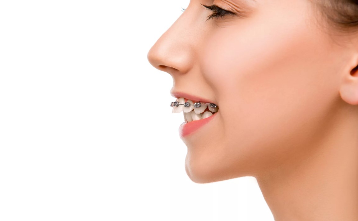 Orthodontics Australia | Overjet And Overbite: Difference, Causes And ...