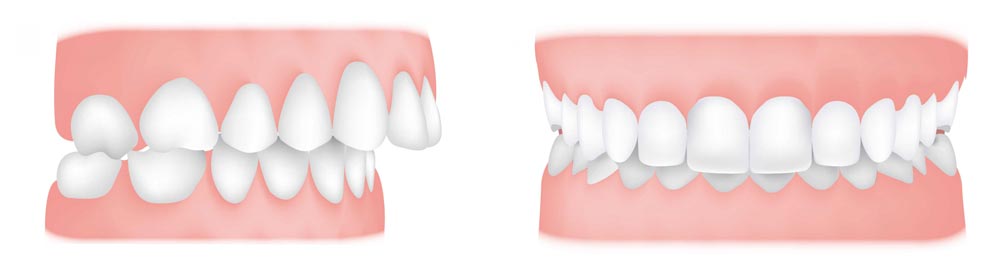 Orthodontics Australia  Overjet and Overbite: Difference, Causes and  Correction Options