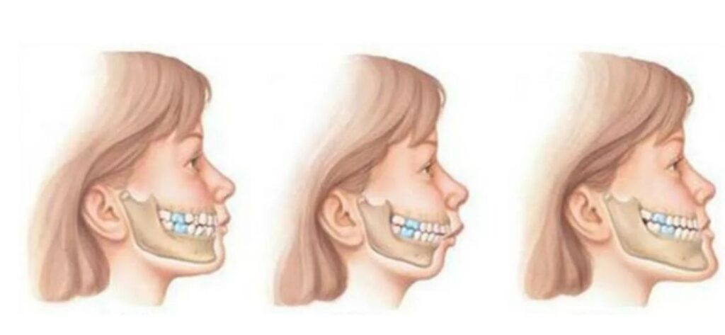 how to treat malocclusion