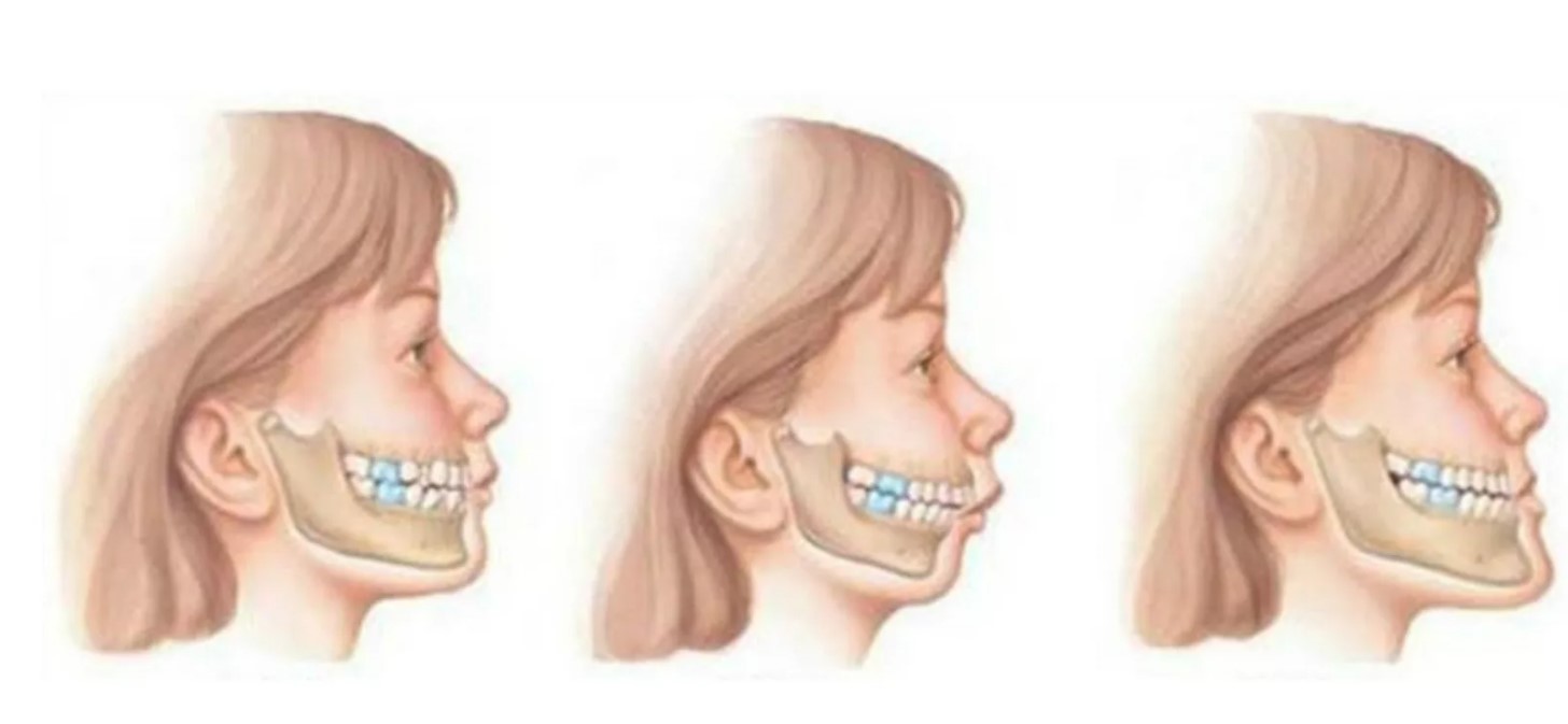 Orthodontics Australia Malocclusion Of Teeth Causes Symptoms And