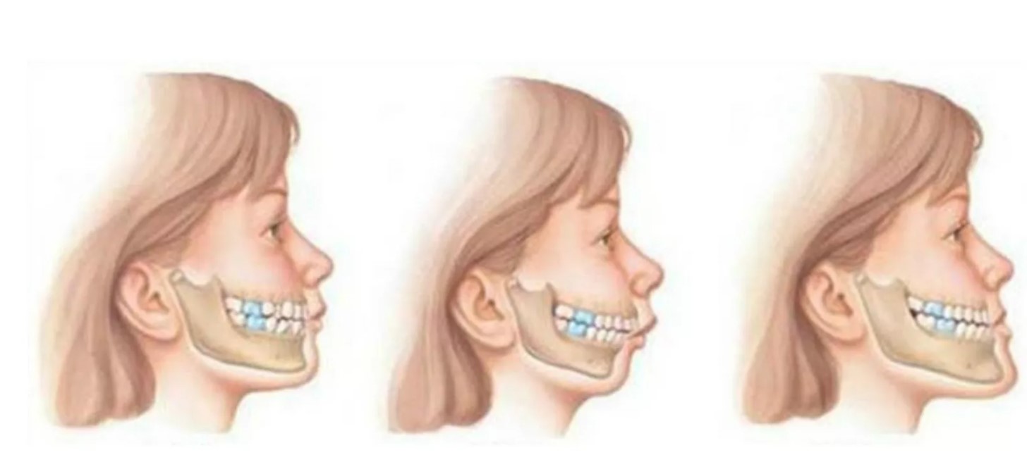 orthodontics-australia-malocclusion-of-teeth-causes-symptoms-and