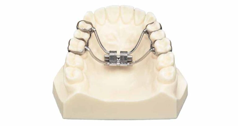 Orthodontics Australia | What is Rapid Maxillary Expansion treatment?