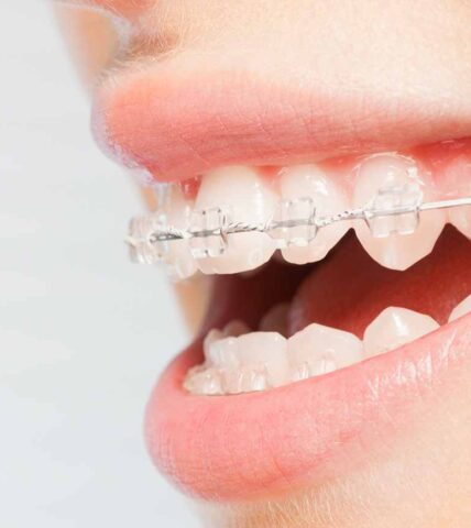 Orthodontics Australia  Average cost of ceramic braces in Australia