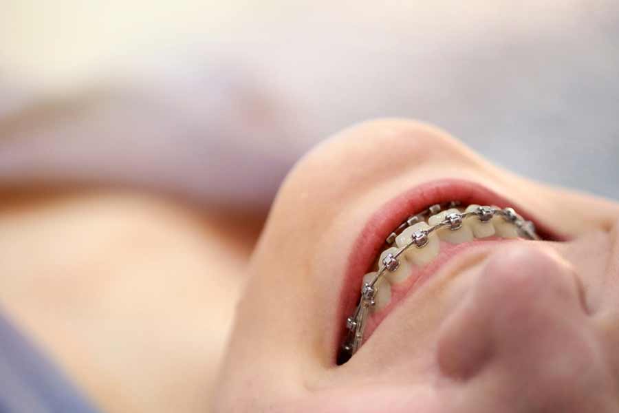 smiling-girl-with-braces-close-up-