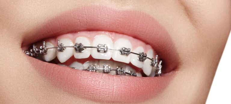 Orthodontics Australia | Can You Chew Gum If You Have Braces?