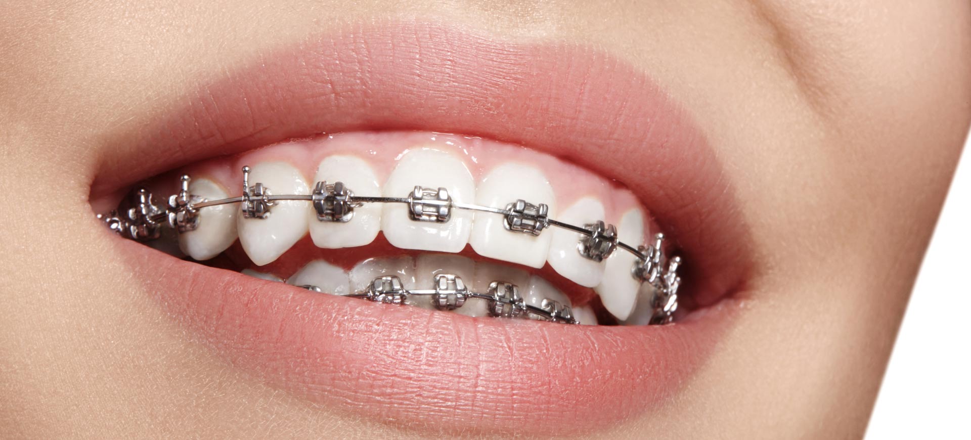 Does chewing gum complicate orthodontic treatment with Braces?