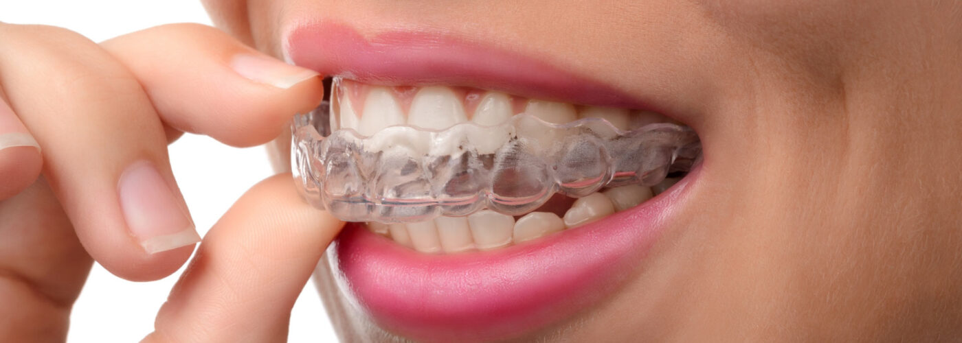 Clear aligners: How much do they cost in Australia?