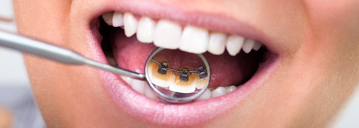 Lingual braces: What are they and how much do they cost?