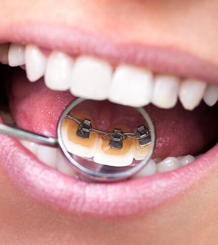 Traditional, Clear, and Lingual Braces - How is Each Used