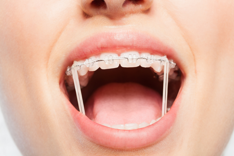 Elastics For Braces Rubber Bands In Orthodontics