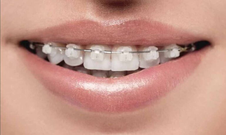 cheap invisible braces