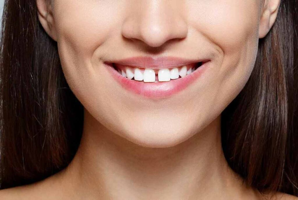 Diastema Or Gaps Between Teeth Causes And Solutions 