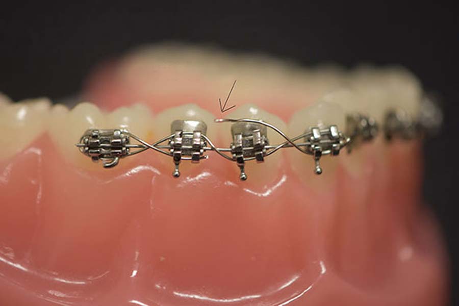 What Happens When Your Braces Wire Breaks at Richard Glisson blog