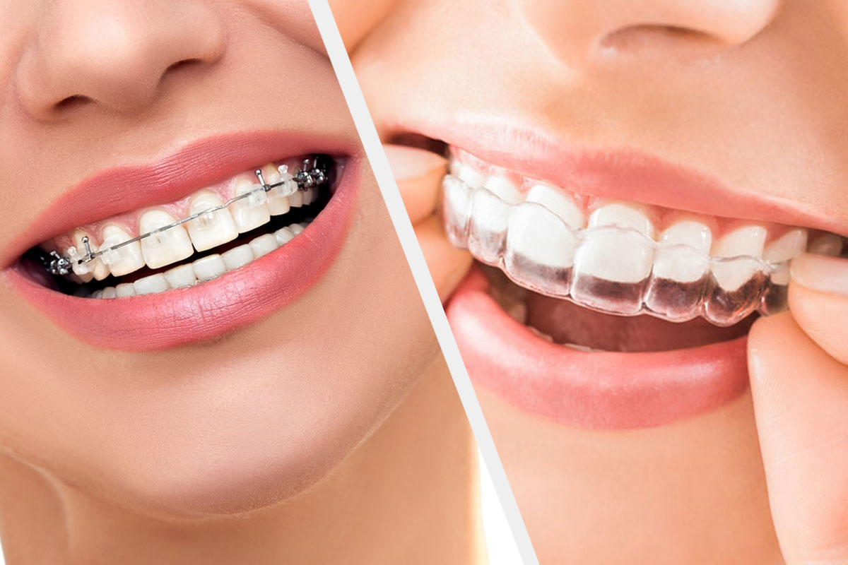 Traditional Braces Vs Clear Aligners Like Invisalign