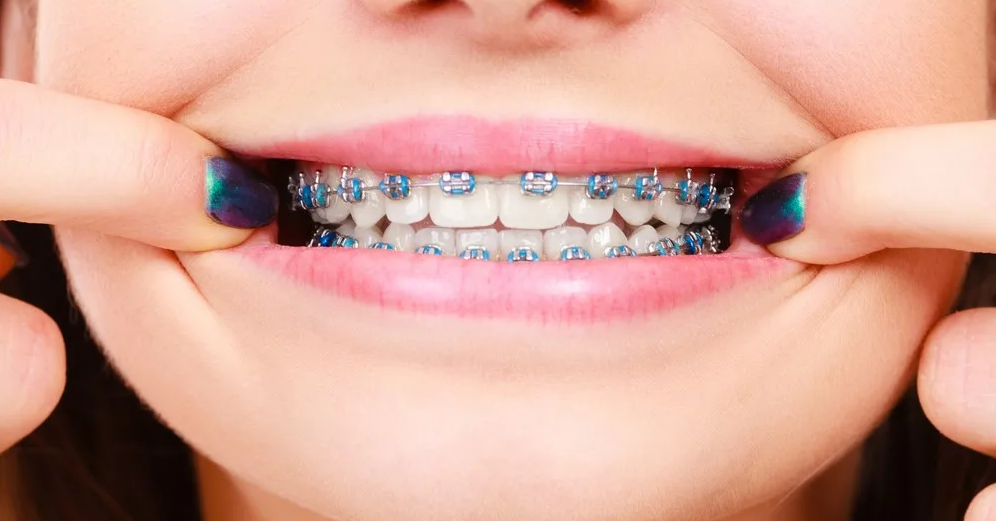 Traditional Braces vs Clear Aligners