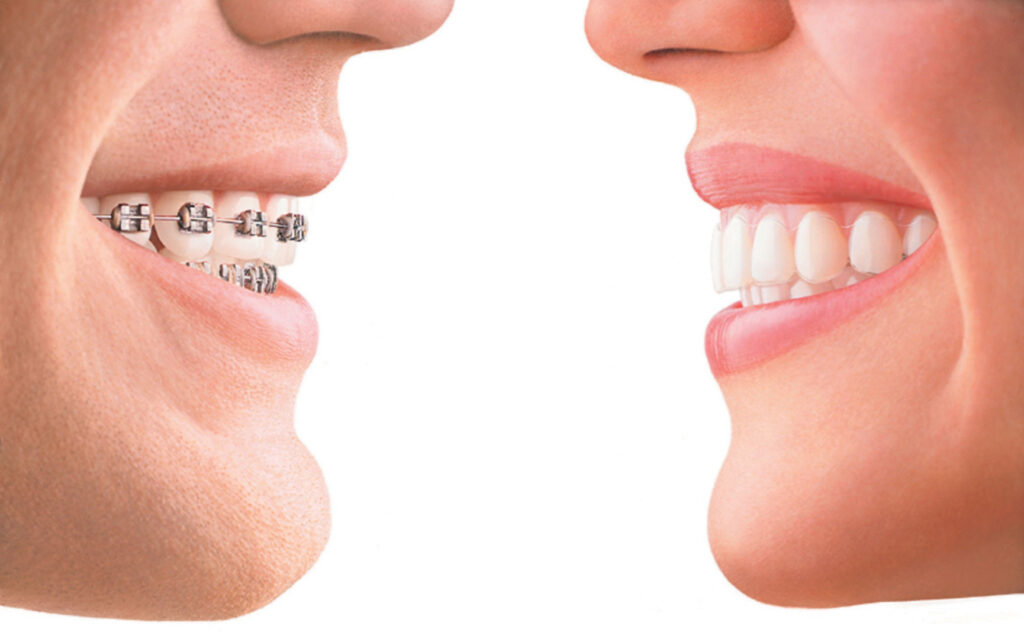 Importance Of Properly Aligned/Straight Teeth