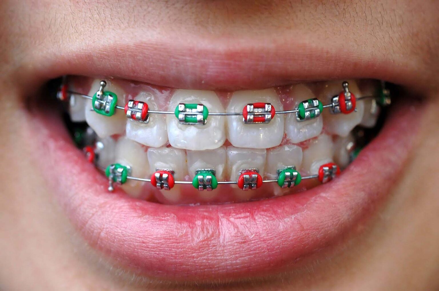 orthodontics-australia-what-to-do-when-your-braces-wire-breaks