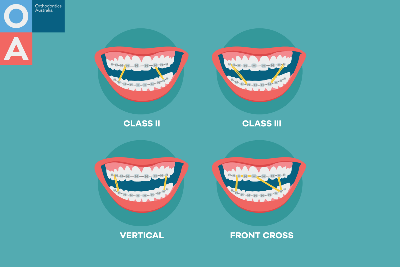 How To Take Out Rubber Bands Braces At Roy Fulgham Blog