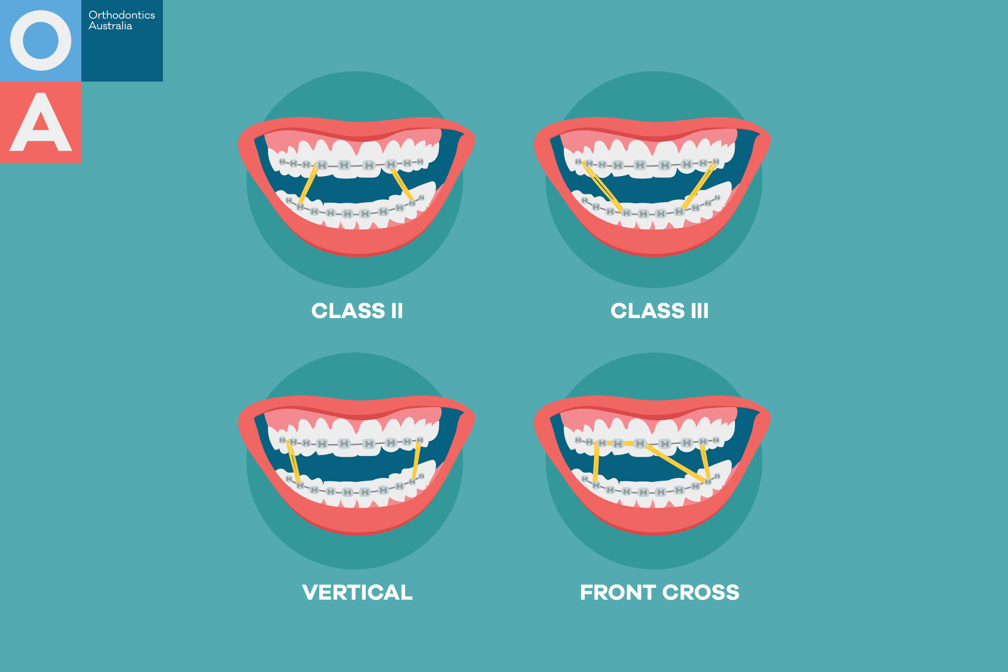 What Are Orthodontic Elastics (Rubber Bands) And How Do They Work