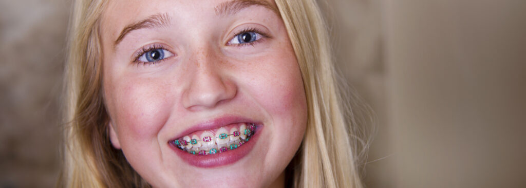 Orthodontics Australia  Elastics For Braces: Rubber Bands in