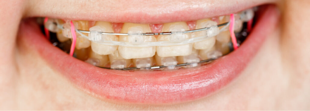 How Orthodontic Elastics Correct Teeth