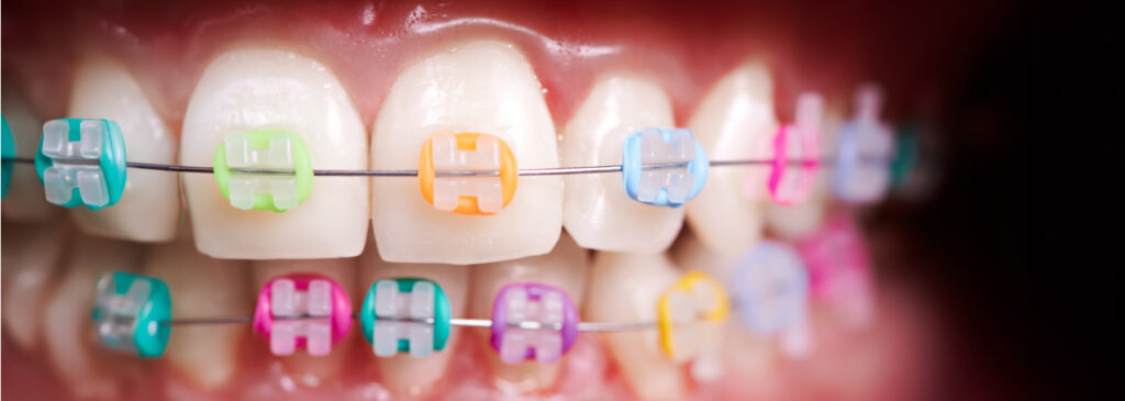 5 Facts About Rubber Bands for Braces That You Must Know