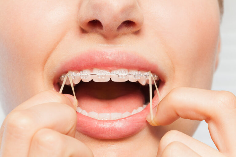 Close-up,Of,Woman,Wearing,Orthodontic,Elastic,Band