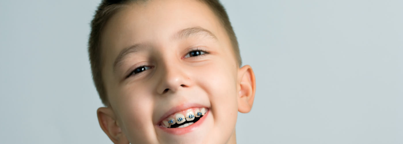 A guide to getting braces on your six front teeth