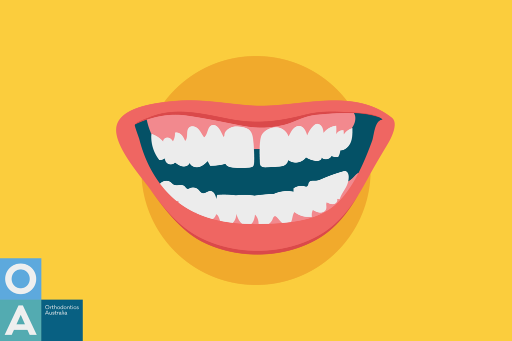Diastema or Gaps Between Teeth: Causes and Solutions