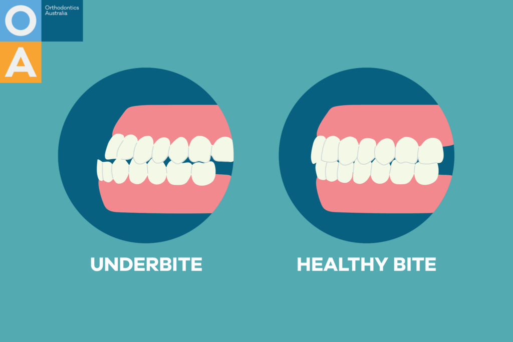 Causes of Underbite and Correction Methods