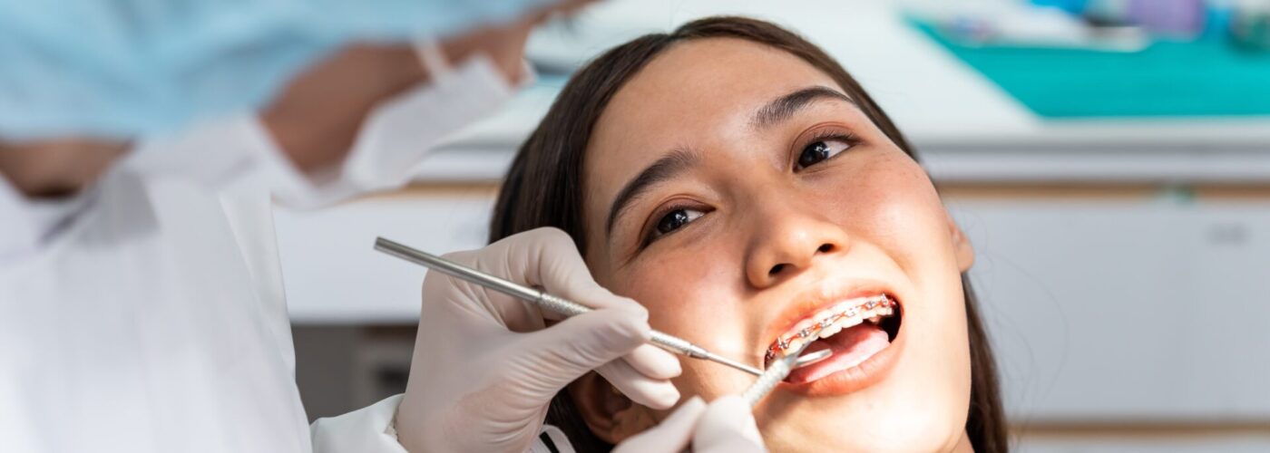 How Are Braces Put On? What You Should Know  
